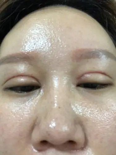 第一次做的埋线双眼皮,因为松皮太多就不明显了,第二_圈子-新氧美容
