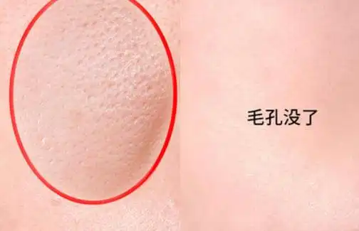 什么原因导致的脸上毛孔粗大?