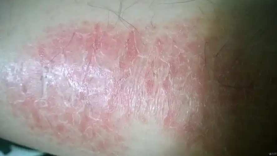 小腿局部皮肤红痒蜕皮请问是什么疾病如何治疗呢