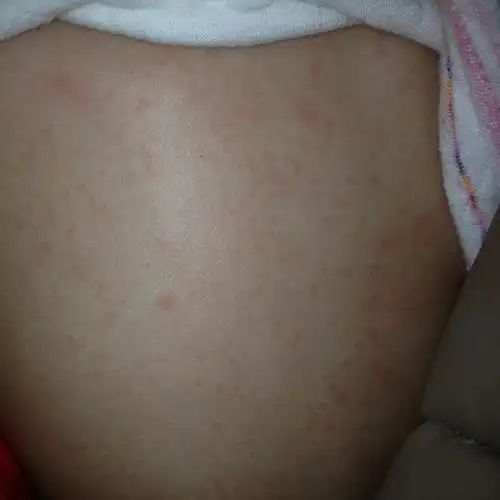 7个半月宝宝突然身上一直到颈部耳部甚至头部有红点点,有经验的家长