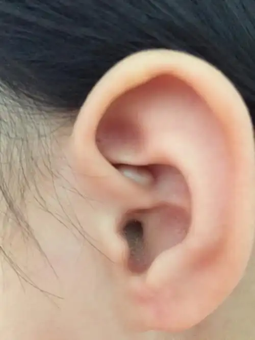 左耳三角窝出现一个白色的囊肿 县人民医院说是耳廓假性囊肿 济南市