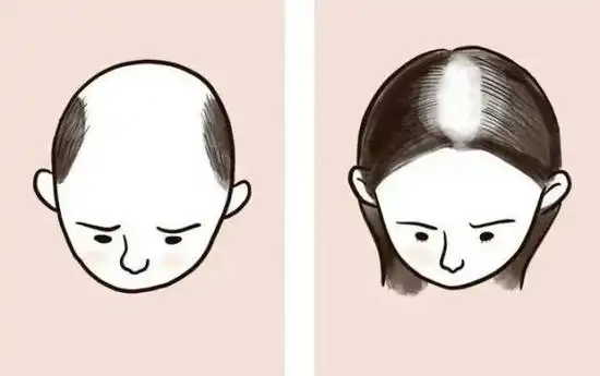 星辉家:干细胞外泌体技术,为脱发患者带来福音