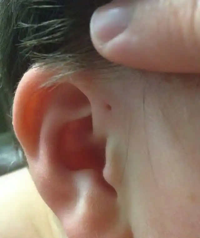 耳朵上的"小包",这其实叫做达尔文结节,据说拥有这个特征人,听觉异于