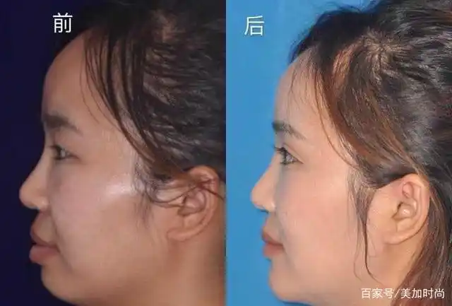 戴牙套一年脸型的变化,哪些人戴完牙套能变美?