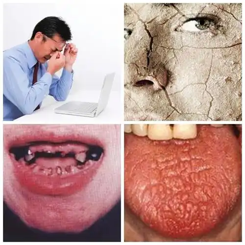 干燥综合症的症状表现