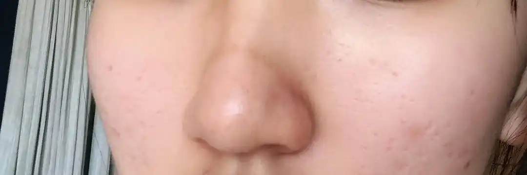 鼻子上莫名其妙有一道印?