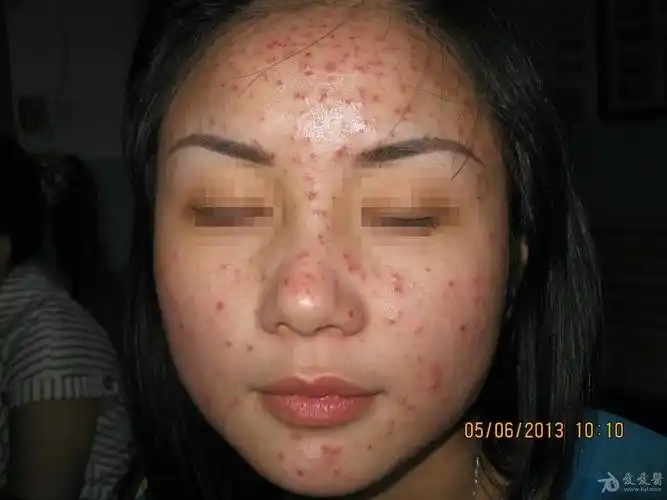 这是痘痘吗--------------马拉色菌毛囊炎