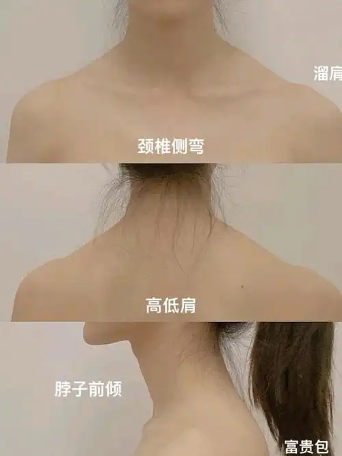 改善斜方肌对我这个真的有用吗?