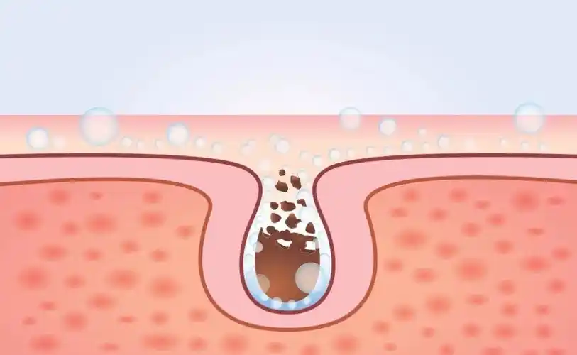 如何去除毛孔粗大?