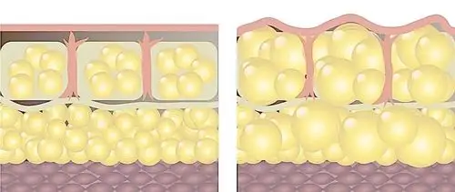 脂肪填充如何让效果翻倍