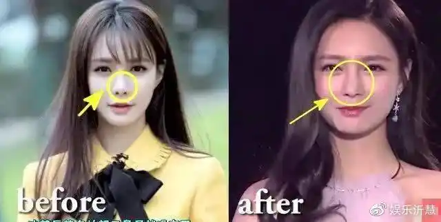 王一博山根透光引热议,医生曾指其缩鼻翼,多位明星因此被疑整容