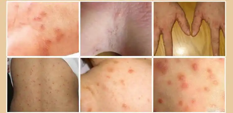 芥舒康疥舒疥疮结节庎舒硫磺软膏疥螨虫卵囊皮肤瘙痒疥虫