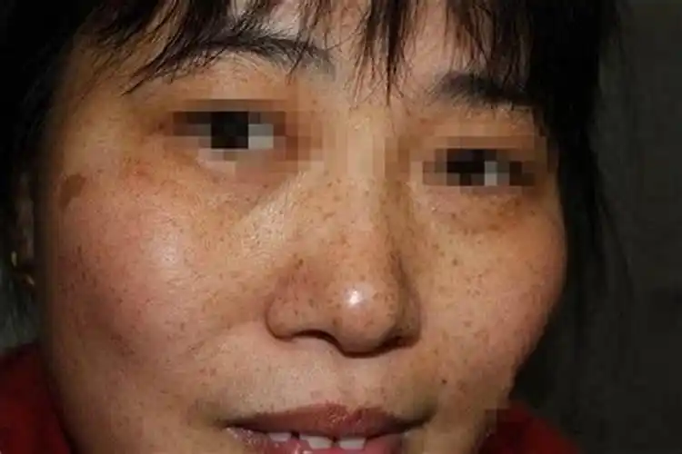 脸色暗沉发黑是什么病的前兆?脸发黑发暗是什么征兆图片-敏感肌-护肤-