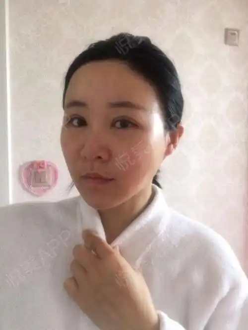 自体脂肪面部填充术后7天_面部填充术后7天_自体脂肪术后7天_面部轮廓