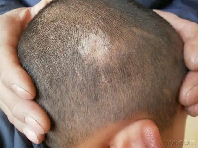 皮肤病头癣白癣