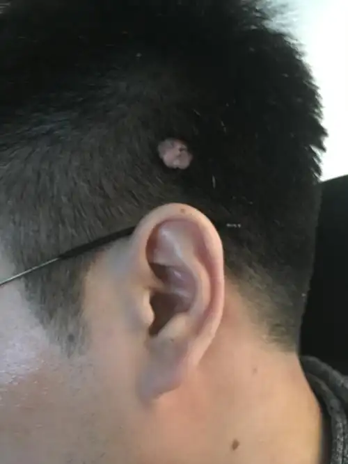 我头上有一个拇指大小的肉瘤是小时候因为皮肤发痒抓的起了一