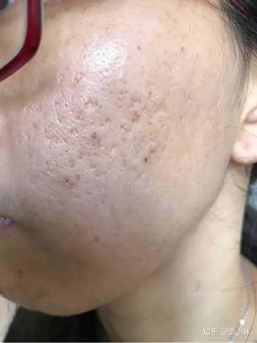 我女朋友整天往脸上糊各种水各种霜,皮肤还是很不好,毛孔粗大,皮肤糙