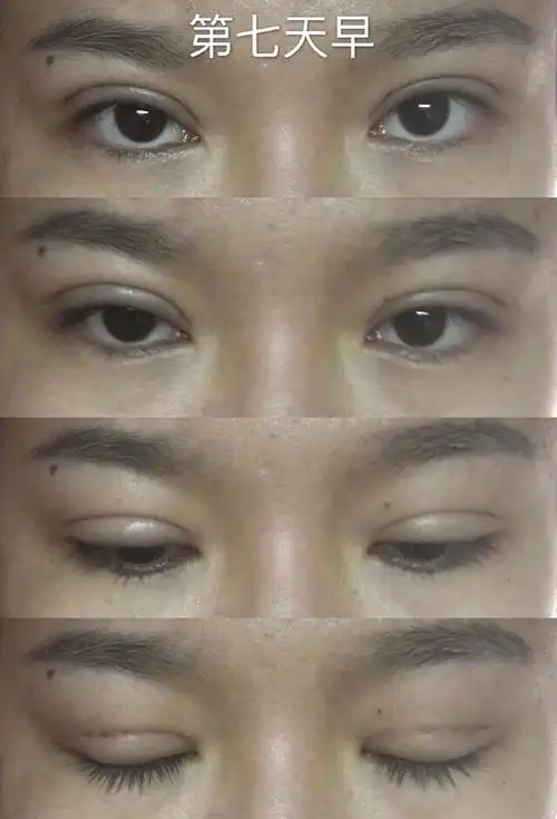 两个多月了!埋线双眼皮63天记录!