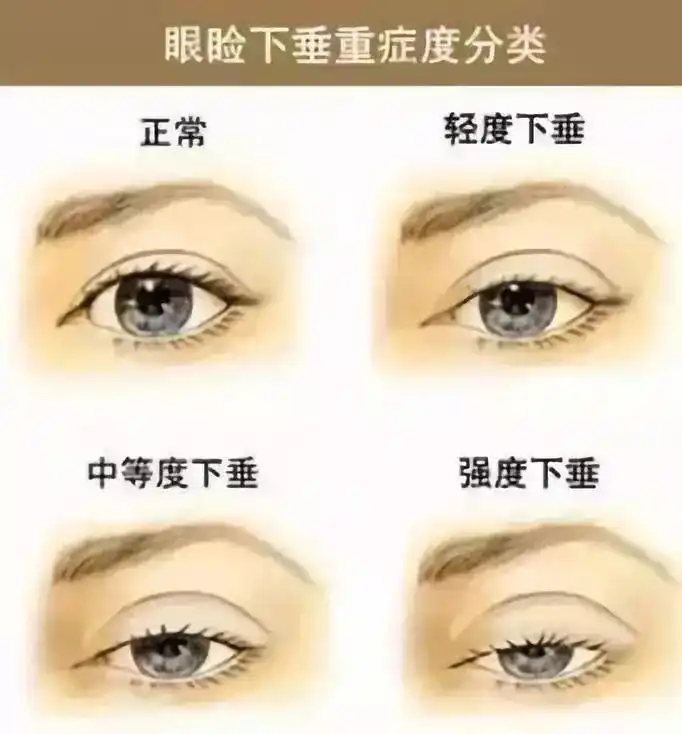 上睑下垂有点严重怎么办