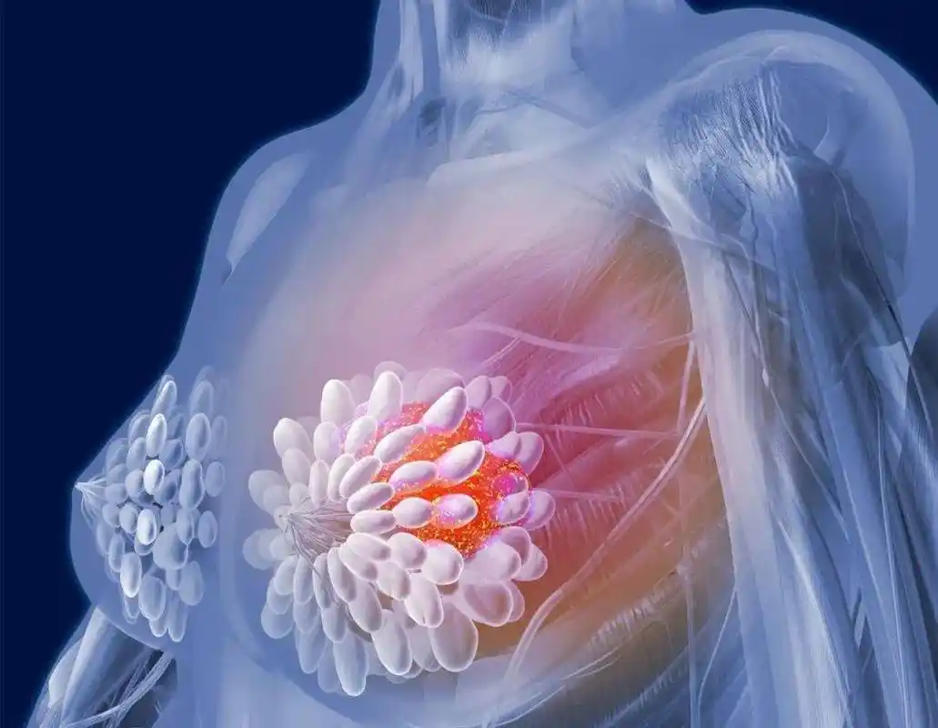 灸除乳腺地雷,做健康女人!_乳房