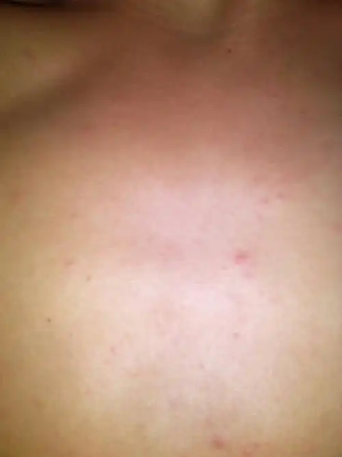 请问我胸口长的这些是什么啊?平时我挺注意个人卫生的,怎会回事啊?