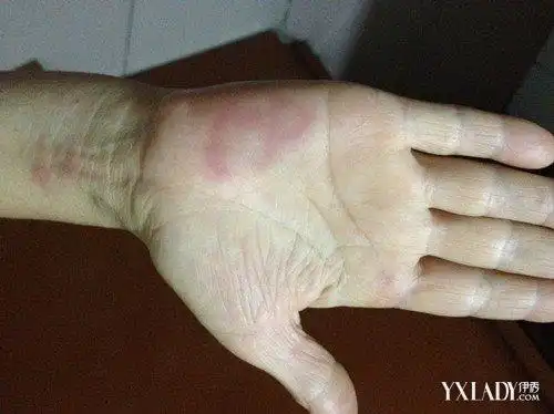 【图】血热皮肤病图片 血热的治疗方法首先是食疗(3)_血热皮肤病_女物