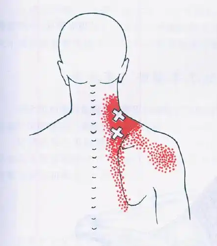 原创你的下巴能碰到肩膀吗感觉疼痛试试这个动作拉伸肩胛提肌