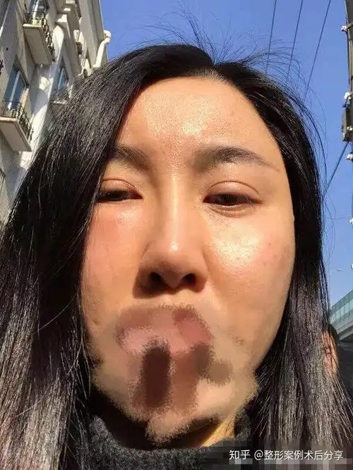 做双眼皮 脂肪填充1年多了,右边眼袋脂肪还是肿胀着,眼窝凹陷,眼皮