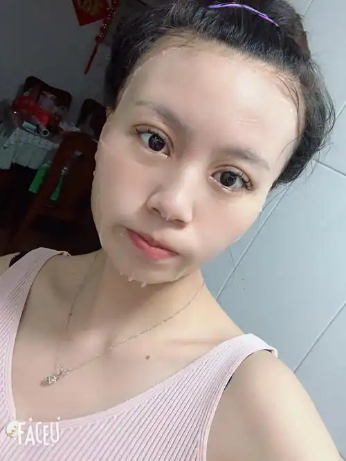 埋线双眼皮第七天