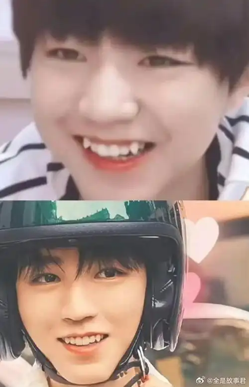 王俊凯居然没有虎牙了,虎牙不是挺好看的吗?