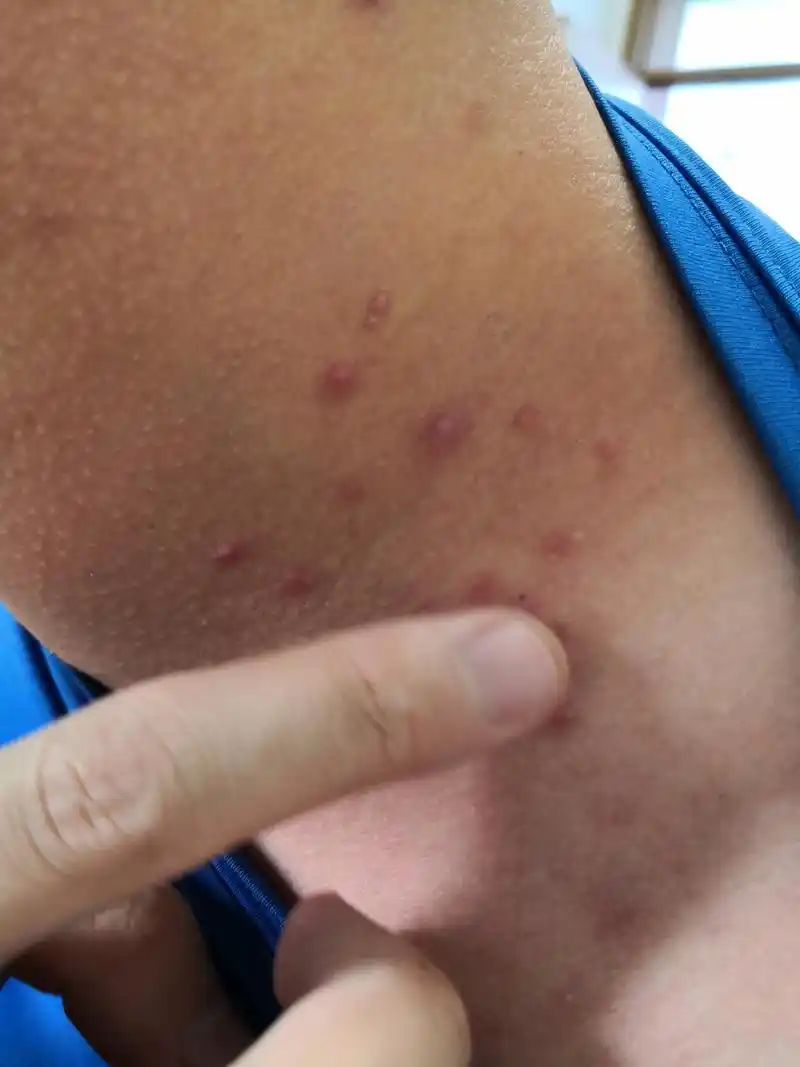 颈周及前胸后背散发的毛囊炎性丘疹脓疱.