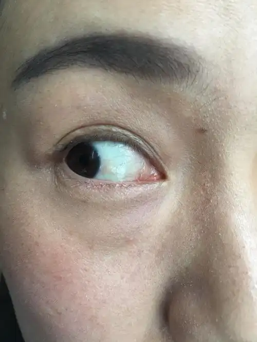 李医生你好第一张是一个月前的泡性结膜炎的照片第二张是上