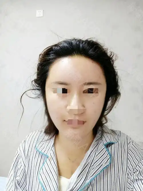 自体脂肪填充全脸