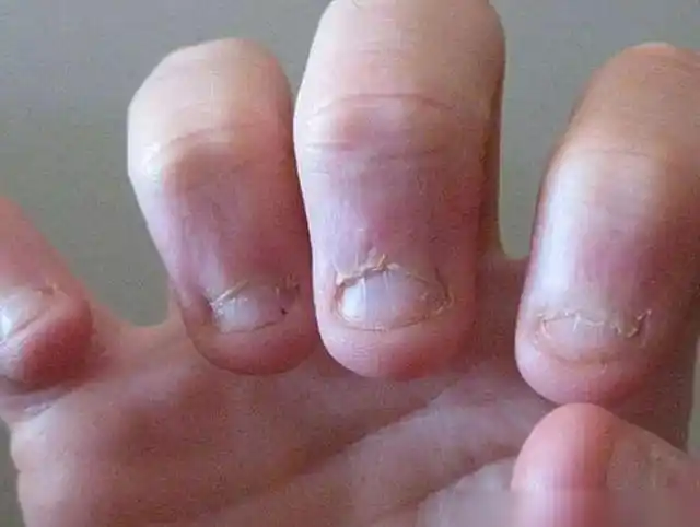 从小啃指甲的孩子,长大后怎么样了?