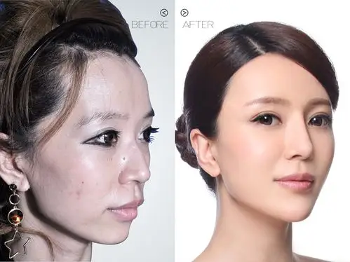 电台主持人郭小姐打美白针前后对比