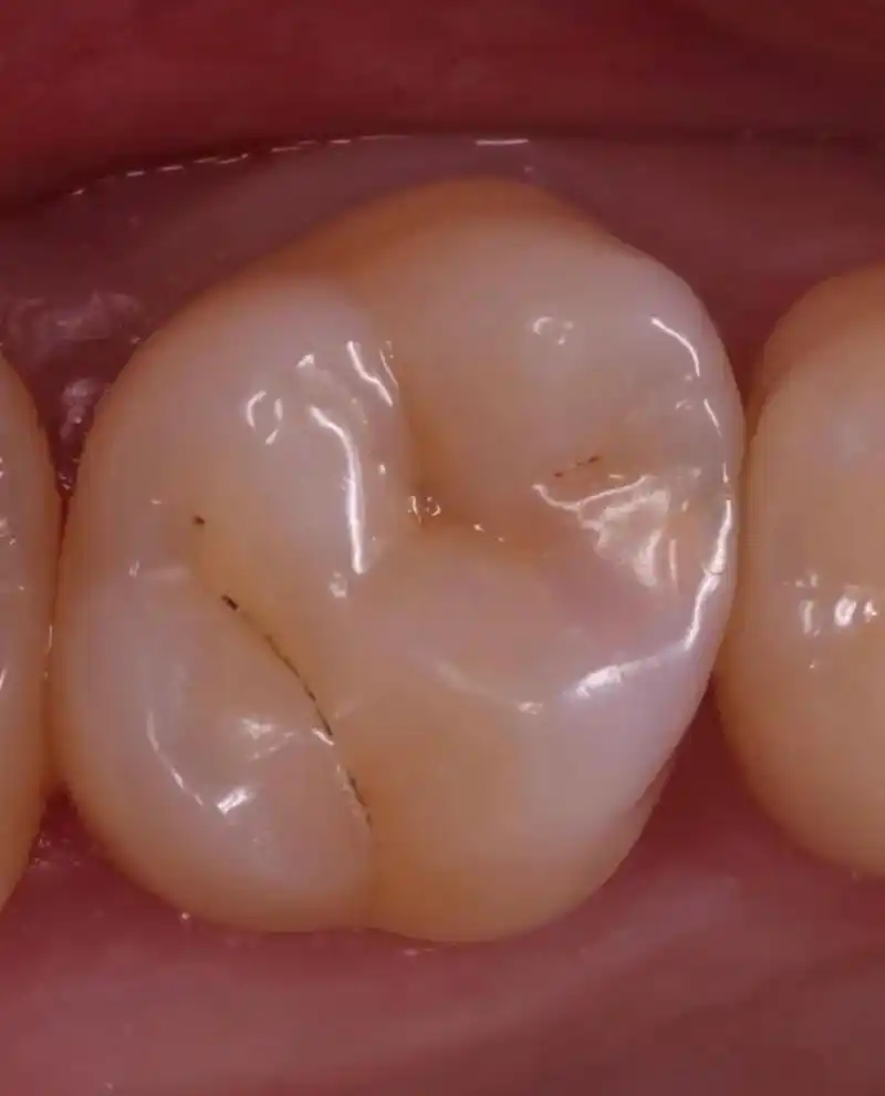 #牙齿🦷 #口腔健康#龋齿 当心看不见的龋齿(虫牙)🤨, - 抖音