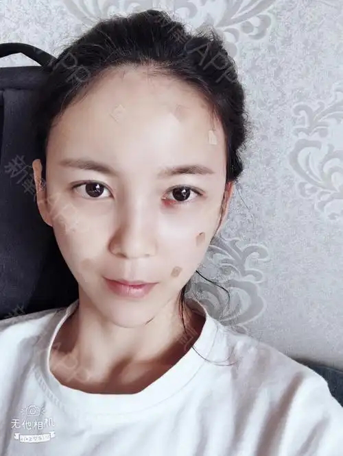 自体脂肪面部填充