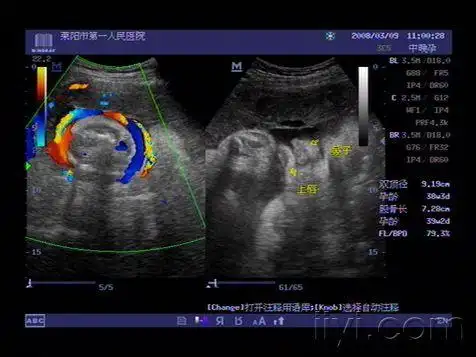 胎儿脐带绕颈及唇部欣赏 - 超声医学讨论版 - 爱爱医医学论坛