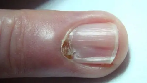 这种毛病千万不要误诊为灰指甲