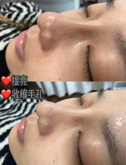不如超光子
真实效果看的见
再贵的护肤品不如超光子改善皮肤粗糙