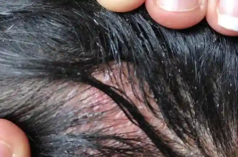 头皮为什么总是很痒头皮发痒什么原因