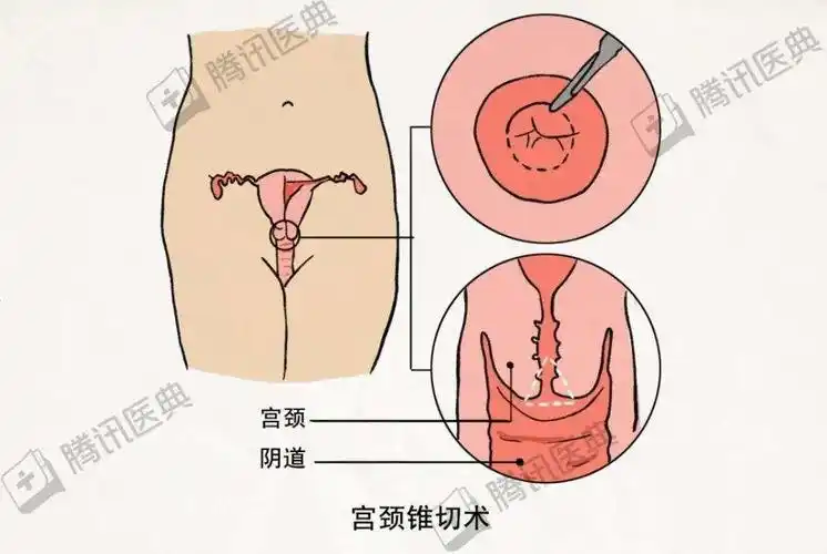 概述子宫颈锥形切除术是一种宫颈局部切除性手术,是诊断和治疗宫颈癌