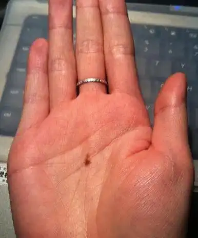 假如痣在掌心,那么你还遇到一个手掌心有痣的人,而且两个人将手合拢