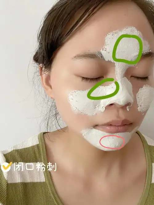 粉刺闭口有救了呜呜