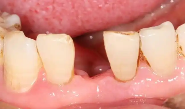 牙齿缺失的情况有哪些?