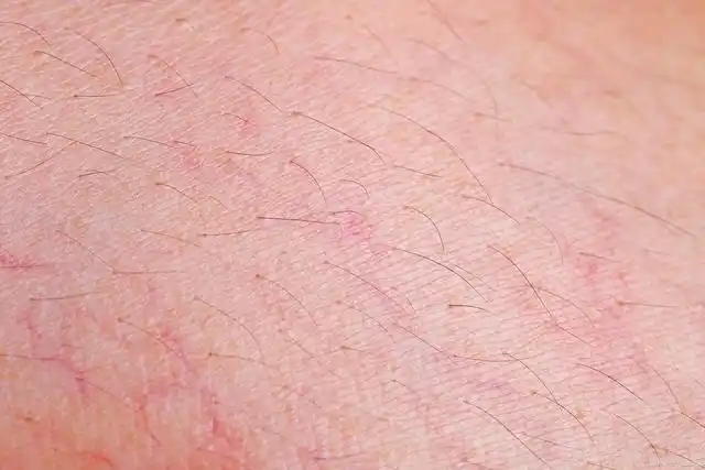 朵嘉浓红血丝该怎么办面部条状网状红血丝有没有好的修复教程