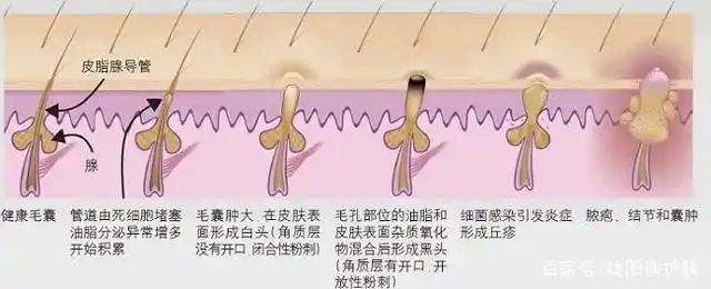 黑头是怎么形成的?为什么总是挤了又长?怎么消除?