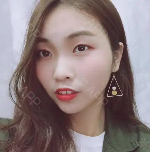 君子好逑w下颌角整形第71天美丽日记