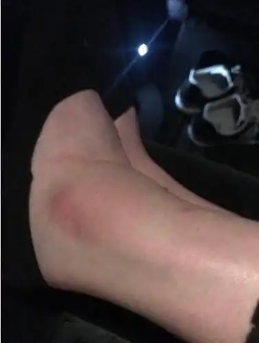 奚梦瑶维密不慎摔跤,脚踝红肿!用七个字回应不会退休?