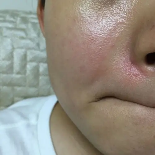 用了几次磨砂洗面奶角质层变薄出现红血丝,一晒太阳还特别的疼,鼻子